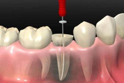 5-essential-tips-for-recovering-after-root-canal-treatment